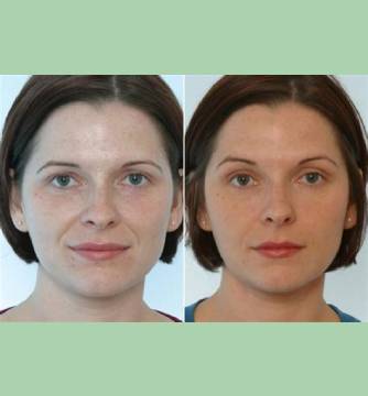 Before and After Images Of Fillers Treatment By Charlottesville, VA In Health & Wellness Spa