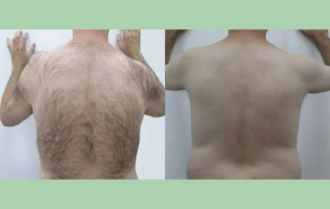 Laser Hair Removal 2 Before and After Magma Charlottesville, VA In Health & Wellness Spa