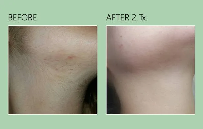 Laser Hair Removal 5 Before and after underarm hair reduction results after 2 treatments.