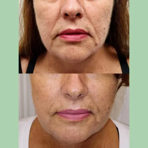 Microneedling - RF Scarlet SRF 6 Before and After Treatment in Charlottesville, VA, by Health & Wellness Spa