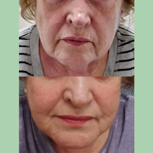 Microneedling - RF Scarlet SRF 5 Facial Rejuvenation Before and After Treatment Charlottesville, VA Health & Wellness Spa