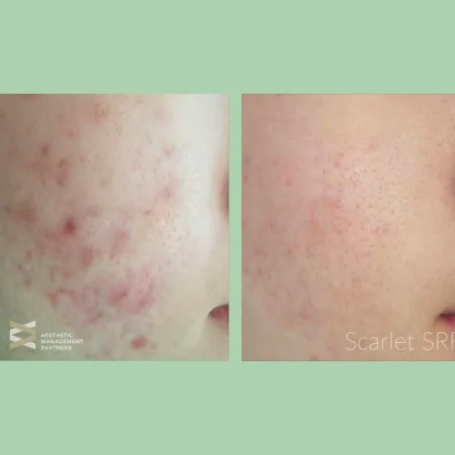 Microneedling - RF Scarlet SRF 7 Before and After MicroNeedling Treatment Charlottesville, VA in Health & Wellness Spa