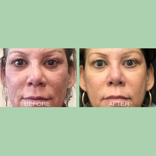 Before and After Images Of Anti-Wrinkle Treatment By Charlottesville, VA In Health & Wellness Spa