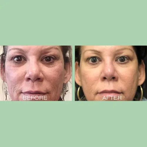 Microneedling - RF Scarlet SRF 8 A woman's face before and after a cosmetic treatment Charlottesville, VA Health & Wellness Spa