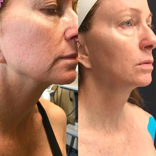 Microneedling - RF Scarlet SRF 3 woman's face before and after a cosmetic treatment