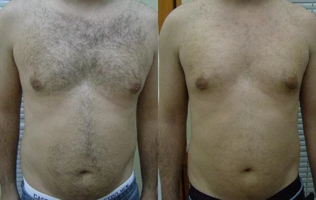 Laser Hair Removal 4 man's torso before and after a hair removal treatment, Charlottesville, VA Health and Wellness Spa