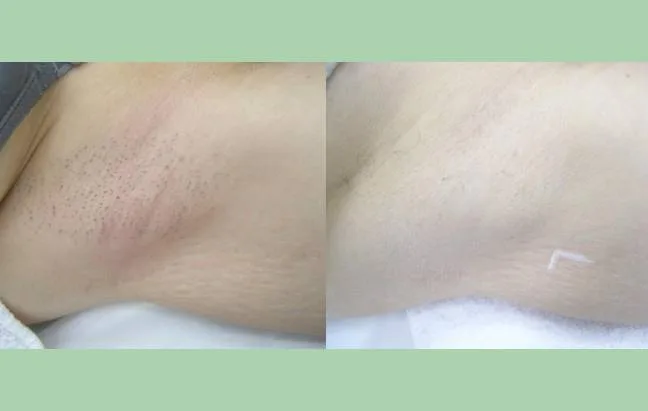 Laser Hair Removal 3 Before and after underarm hair reduction results, Charlottesville, VA, In Health & Wellness Spa