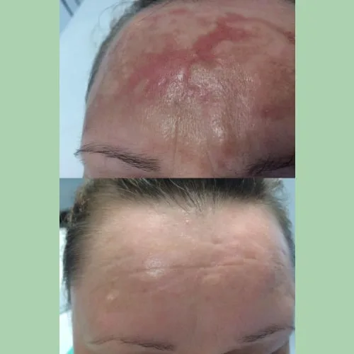 Microneedling - RF Scarlet SRF 4 woman's forehead before and after a treatment, Charlottesville by Health & Wellness Spa