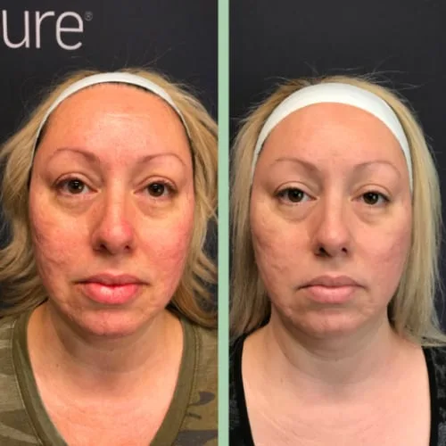 Microneedling - RF Scarlet SRF 2 woman's face before and after a cosmetic treatment, Charlottesville, VA, in Health & Wellness Spa