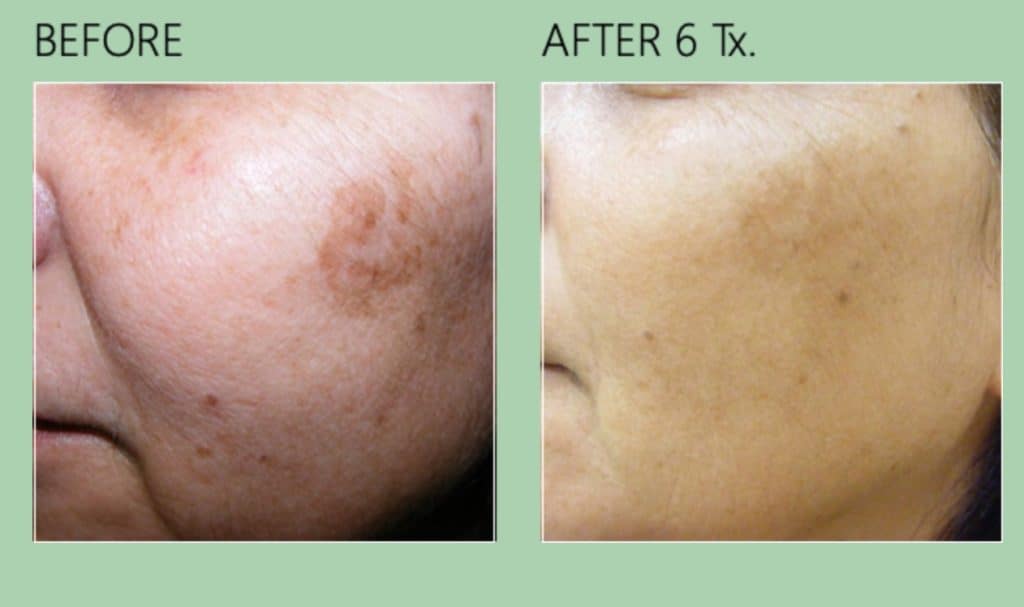 Before and After 2
