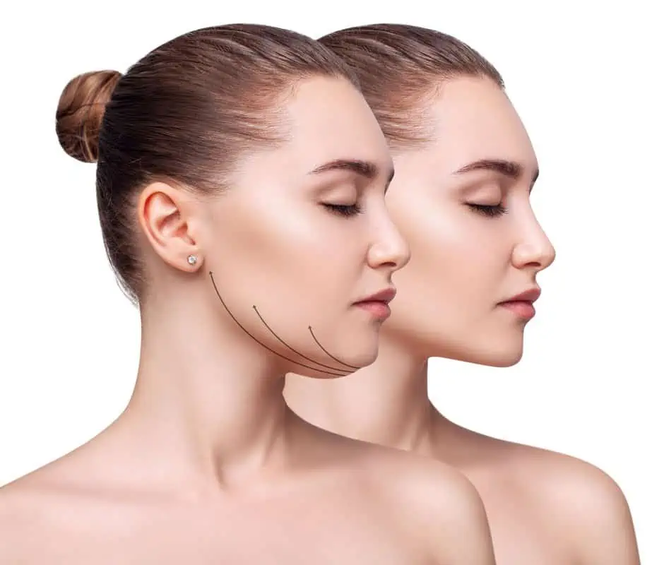 Kybella by Health and Wellness Spa in VA