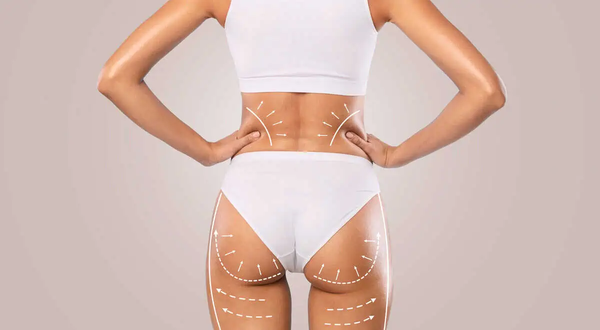 Sculptra Butt | Health and welness Spa in Charlottesville VA