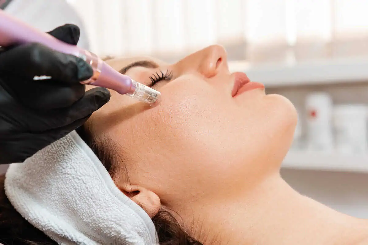 Microneedling Treatment Charlottesville, VA