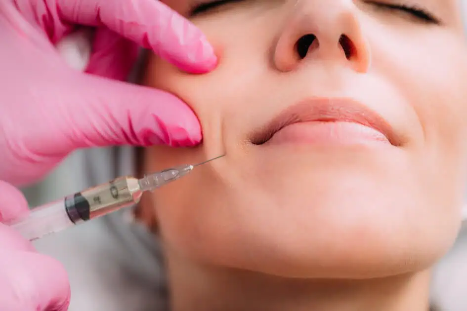 Cheek lift using dermal fillers for facial balance