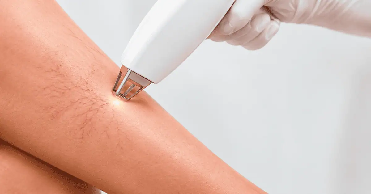 Laser vein treatment reducing the appearance of spider veins on the legs