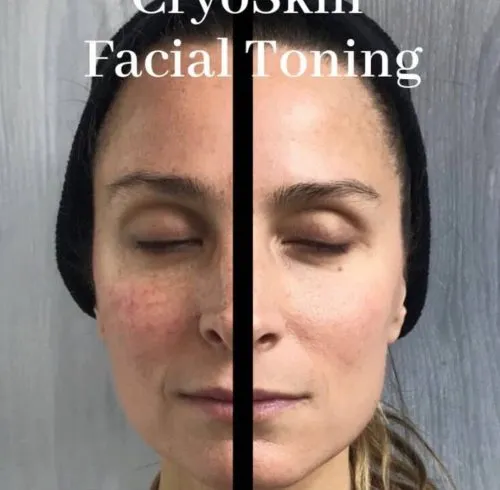 CryoSkin 34 Before and After Cryofacial In Charlottesville, VA By Health & Wellness Spa