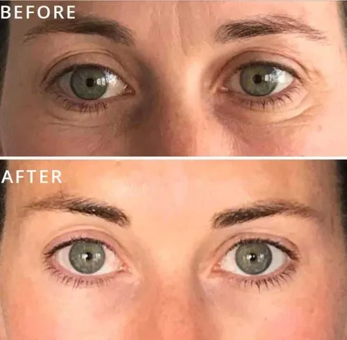 CryoSkin 35 Before and After Cryofacial In Charlottesville, VA By Health & Wellness Spa