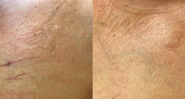 Before And After Images Of Magma laser By Charlottesville, VA In Health & Wellness Spa