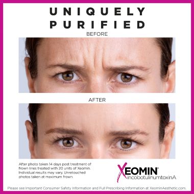 Before & After Image Of Xeomin Treatment In Charlottesville, VA By Health & Wellness Spa