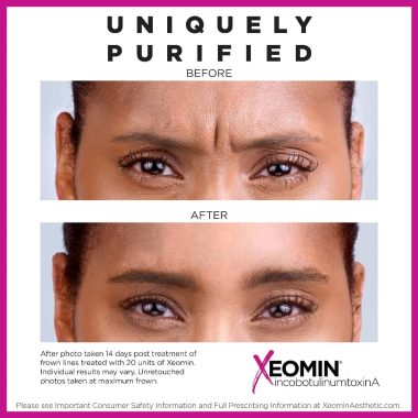 Before & After Image Of Xeomin Treatment In Charlottesville, VA By Health & Wellness Spa