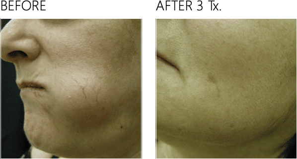 Before And After Images Of Magma laser By Charlottesville, VA In Health & Wellness Spa