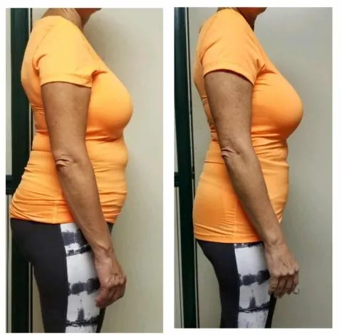 CryoSkin 8 Before And After Slimming Treatment Charlottesville, VA by Health and Wellness Spa