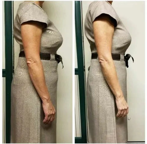 CryoSkin 7 Before And After Slimming Treatment Charlottesville, VA by Health and Wellness Spa