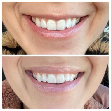 Before & After Image Of Lip Flip Treatment In Charlottesville, VA By Health & Wellness Spa