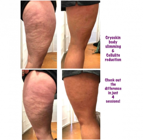 Cellulite Treatment By Charlottesville, VA In Health & Wellness Spa