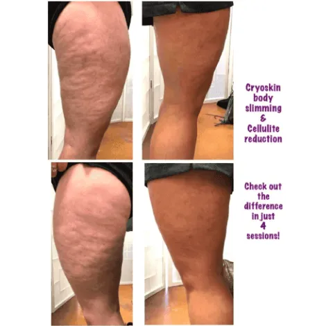 CryoSkin 3 Cellulite Treatment Charlottesville, VA in Health & Wellness Spa