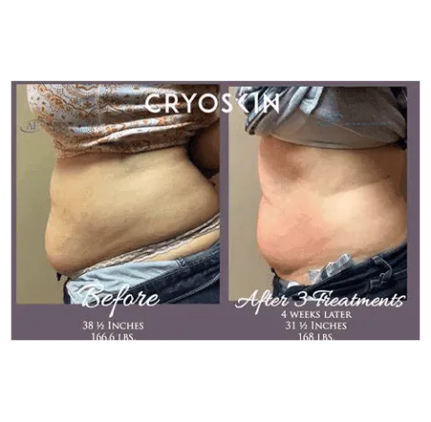 CryoSkin 5 Slimming Treatment Charlottesville, VA in Health & Wellness Spa