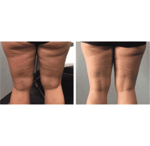 Slimming Treatment By Charlottesville, VA In Health & Wellness Spa