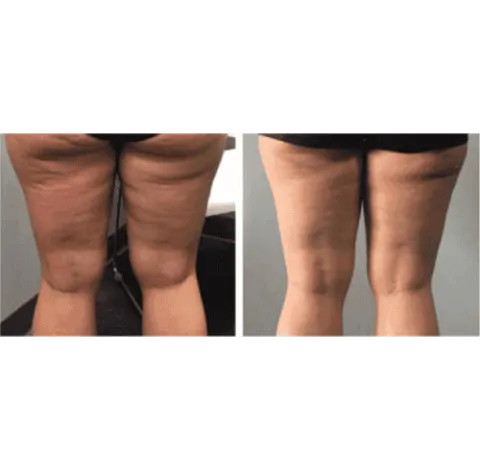 CryoSkin 4 Slimming Treatment Charlottesville, VA in Health & Wellness Spa