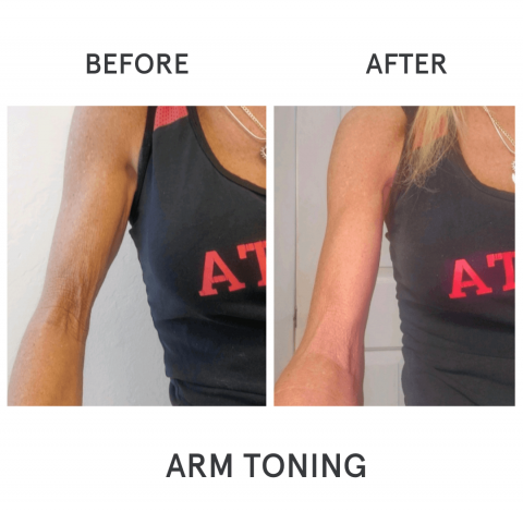 Before & After Image Of Arm Toning In Charlottesville, VA By Health & Wellness Spa
