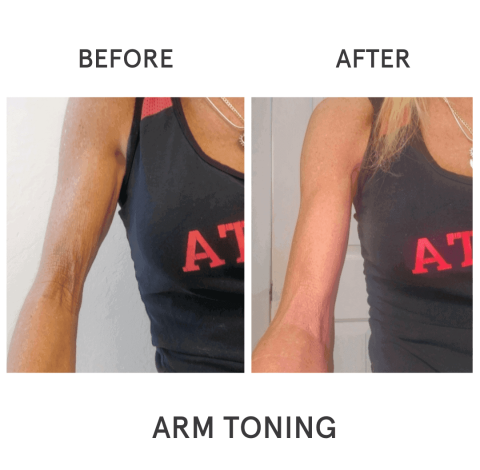 Before & After Image Of Arm Toning In Charlottesville, VA By Health & Wellness Spa