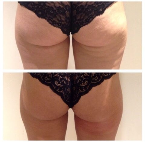 Before & After Image Of Toning In Charlottesville, VA By Health & Wellness Spa