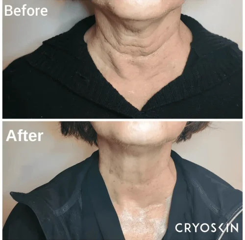 Before & After Image Of CryoFacial Treatment In Charlottesville, VA | Health & Wellness Spa