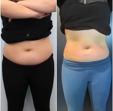 CryoSkin 14 Before and after slimming treatment in Charlottesville