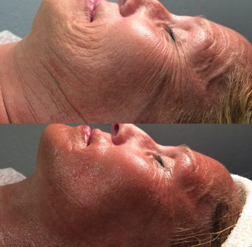 Before & After Image Of Facial In Charlottesville, VA By Health & Wellness Spa