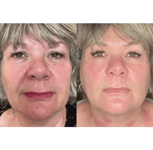 CryoSkin 29 Facial Treatment Charlottesville, VA In Health & Wellness Spa