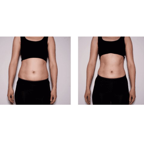 Female Abdomen Toning Treatment By Charlottesville, VA In Health & Wellness Spa