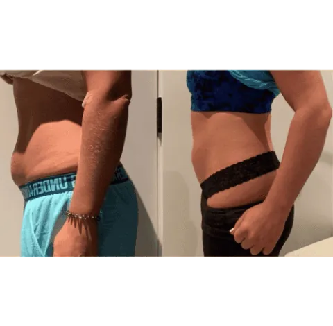 CryoSkin 2 Slimming Treatment Charlottesville, VA in Health & Wellness Spa