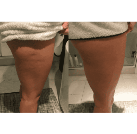 Cryo Slimming Treatment By Charlottesville, VA In Health & Wellness Spa