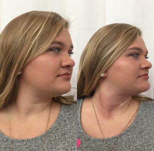 Before & After Image Of Double Chin Treatments In Charlottesville, VA By Health & Wellness Spa