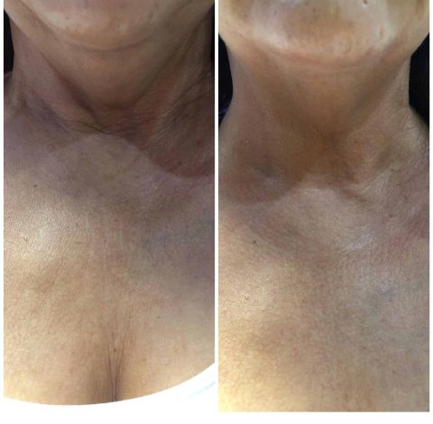 Double Chin Slimming In Charlottesville, VA By Health & Wellness Spa