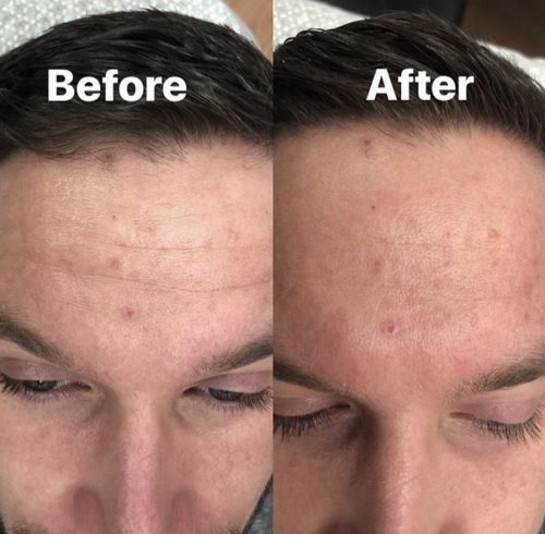 Before & After Image Of Facial Treatment In Charlottesville, VA | Health & Wellness Spa