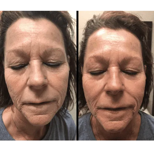 CryoSkin 30 Facial Treatment Charlottesville, VA In Health & Wellness Spa