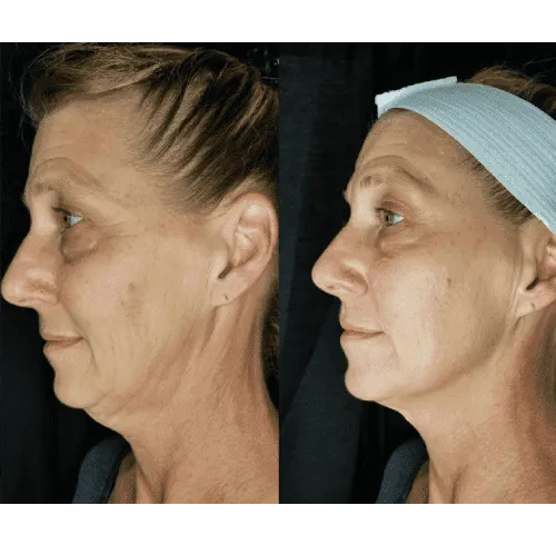 CryoSkin 31 Facials Treatment Charlottesville, VA In Health & Wellness Spa