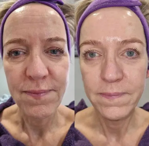 CryoSkin 32 Facials Treatment In Charlottesville, VA By Health and Wellness Spa