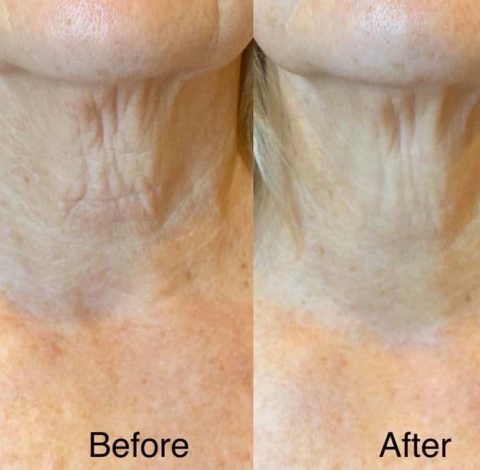Before & After Image Of Neck Toning In Charlottesville, VA By Health & Wellness Spa
